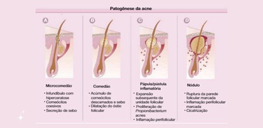 ACNE – Processo Inflamatório na Pele?